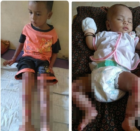 Kadis Kesehatan Madina, Dua Anak di Tambangan Terkena Virus Toxoplasma