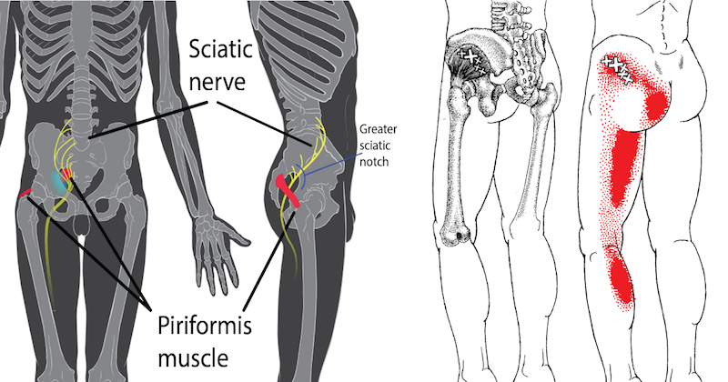 piriformis-syndroom-piriformis-syndroom-nervus-ischia-vrogue-co